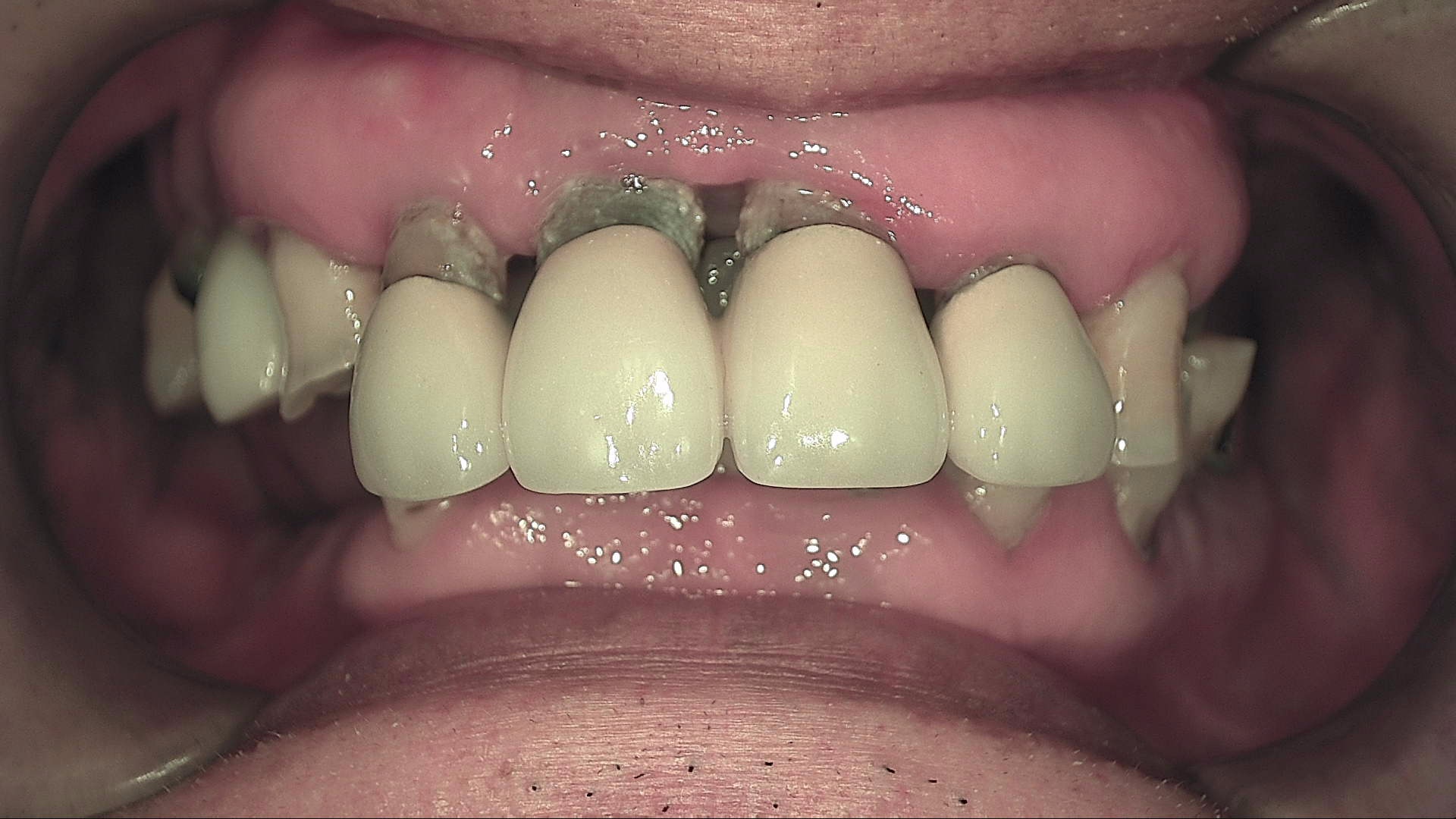 IMPLANT CASE